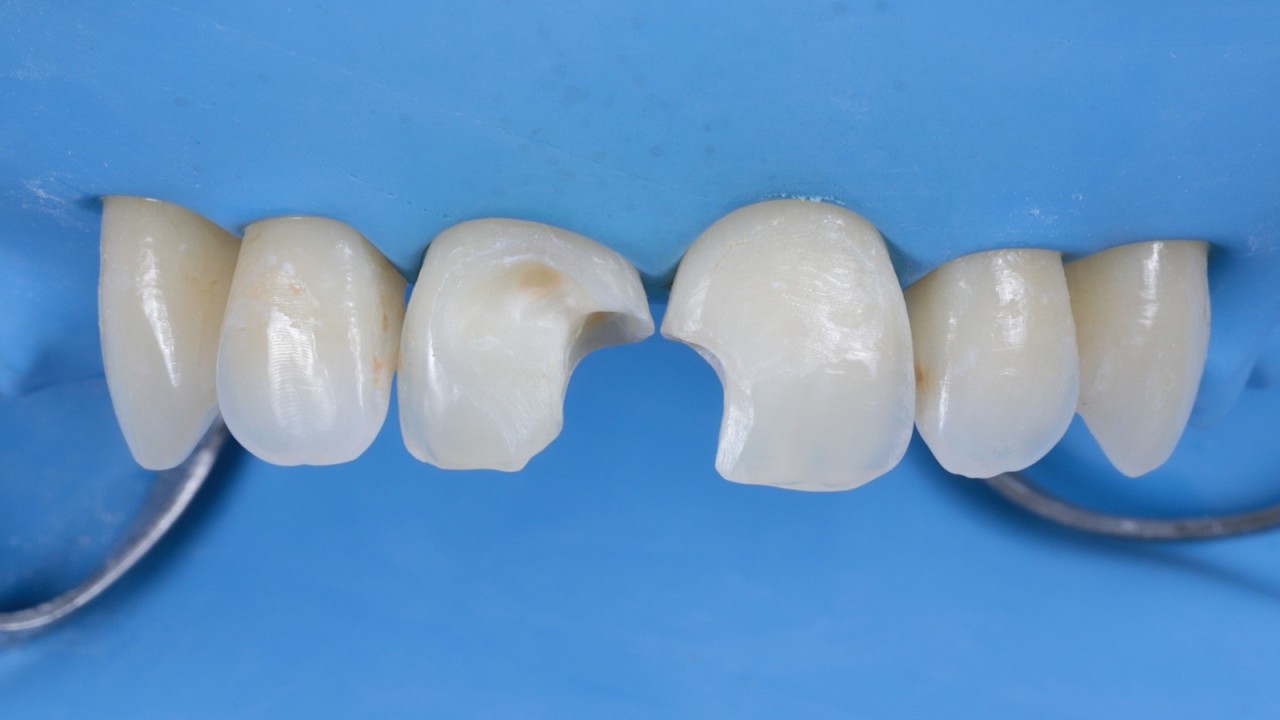 Step 3: Removal of old composite and decayed tissue 