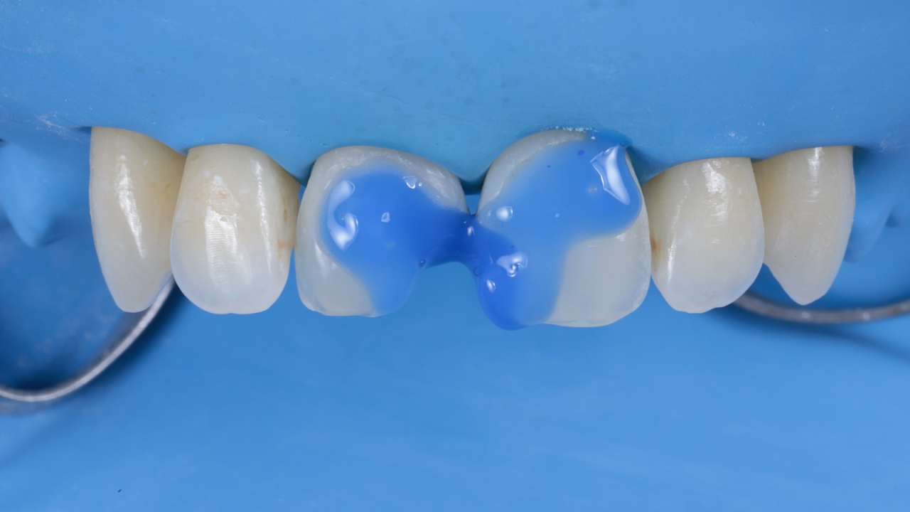 Step 4: Etching and bonding