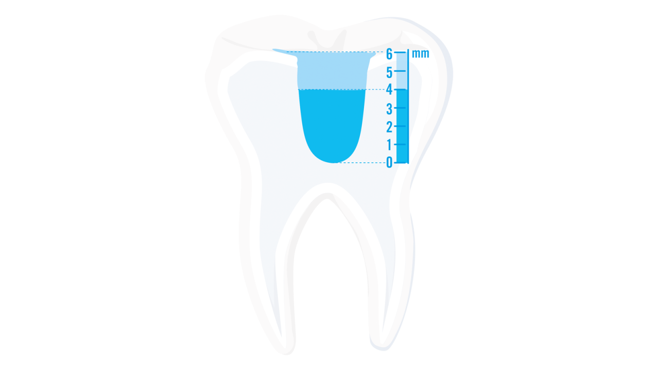 Venus Bulk Flow ONE is ideal for deeper cavities of up to 4mm.