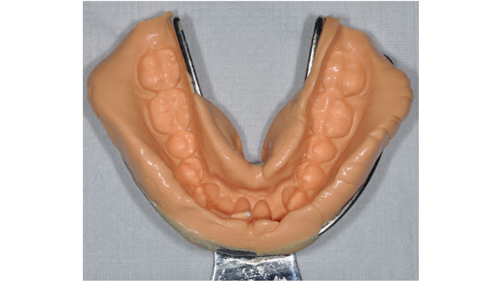 Perfect result of mandibular impression