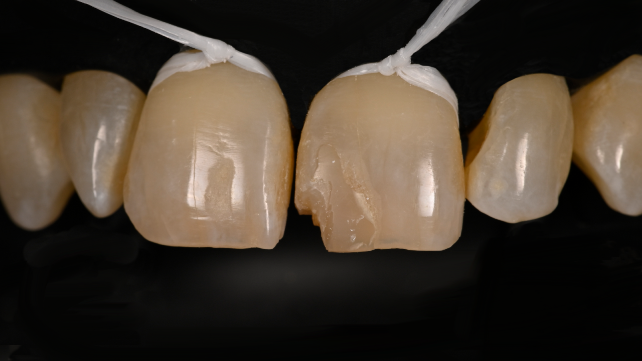 Fracture of tooth 21