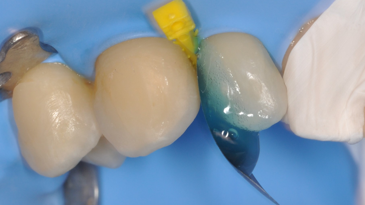 Etching with iBOND Universal