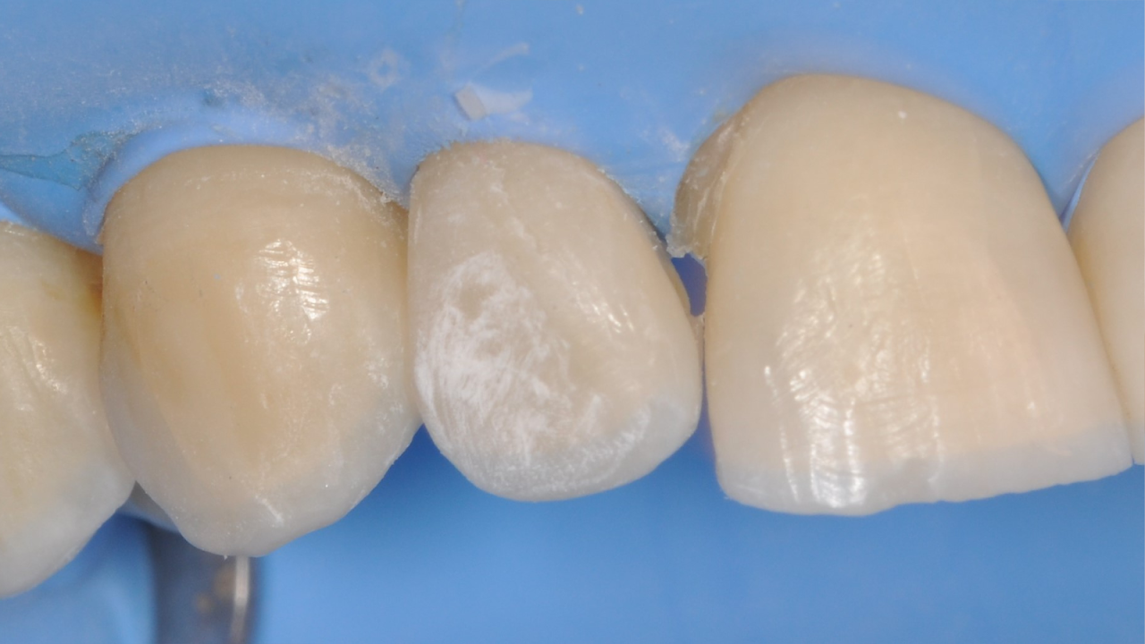 Finishing of the restoration