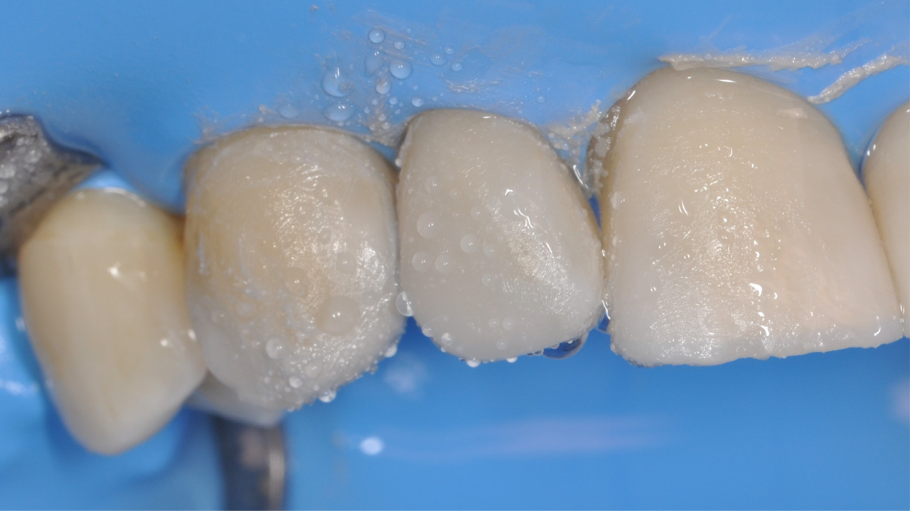 Polishing with Venus Supra two-step polishing system​.