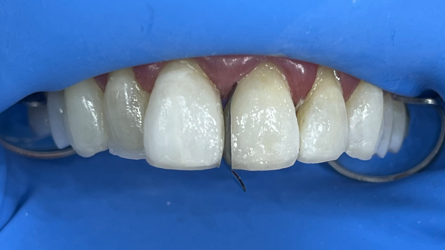 Tooth by tooth reconstruction​