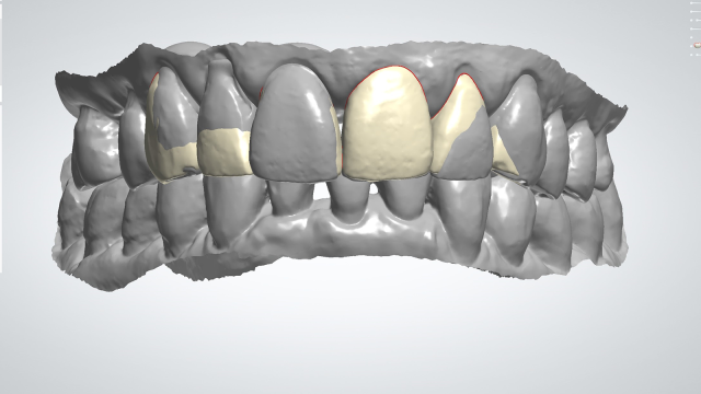 Digital mock-up of the upper teeth​