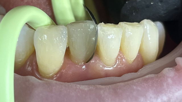 Tooth by tooth reconstruction with composite​