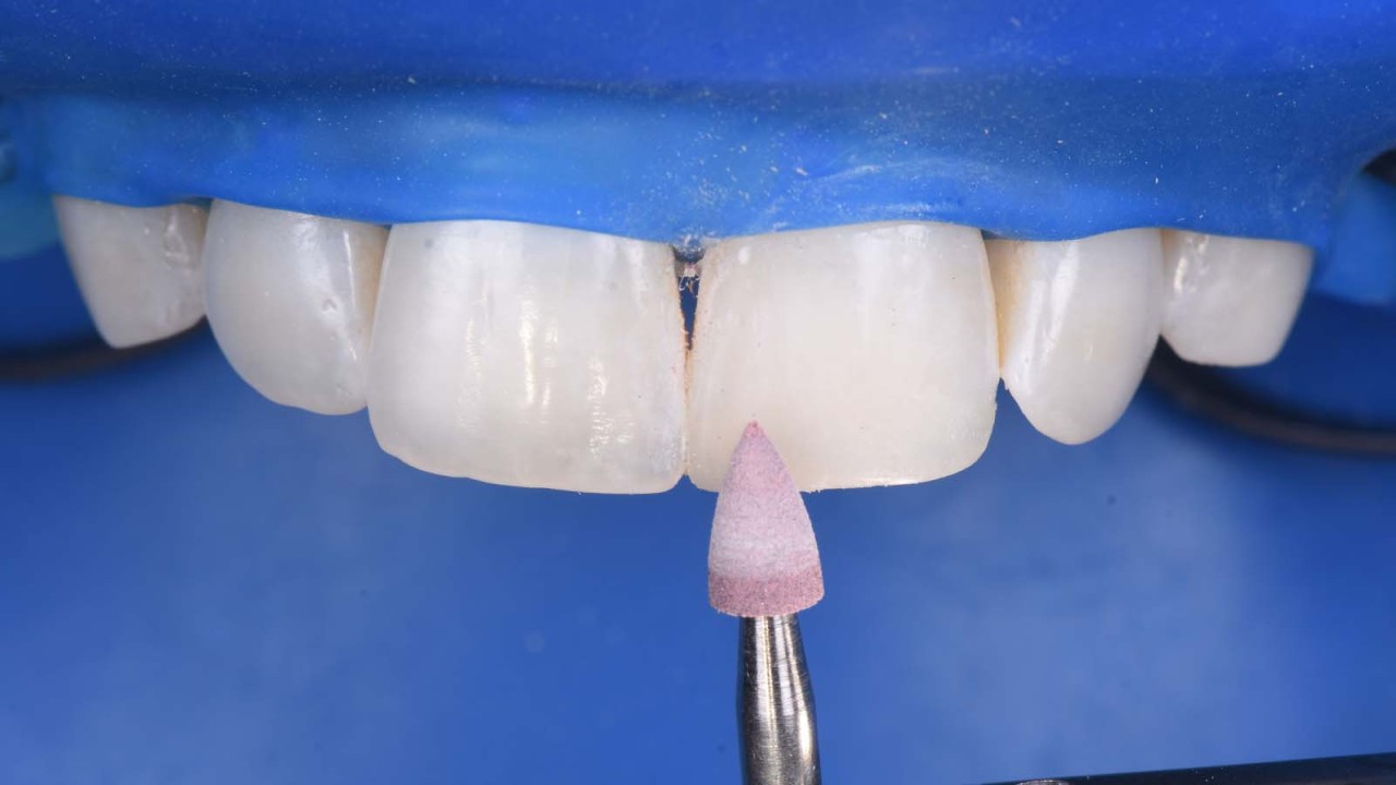 Polishing the composite with the Venus Supra polishing kit.