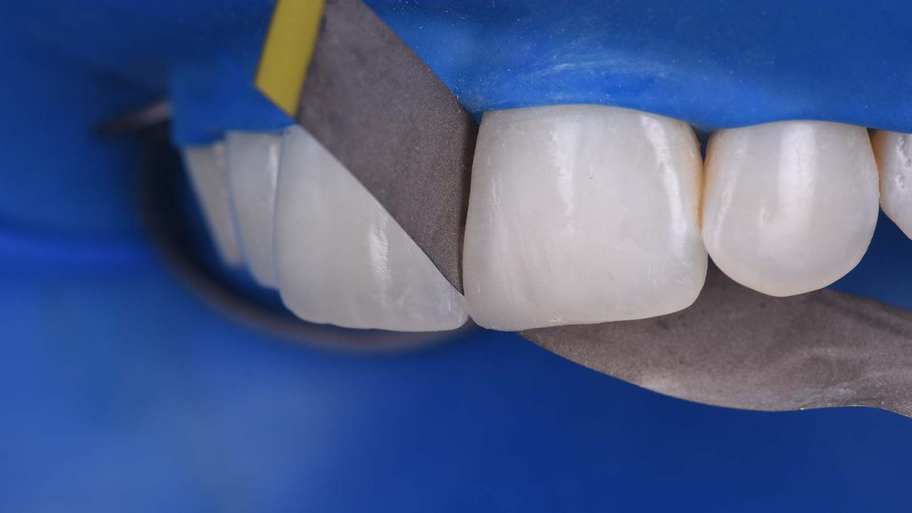 Using a strip to polish the proximal areas of the composite