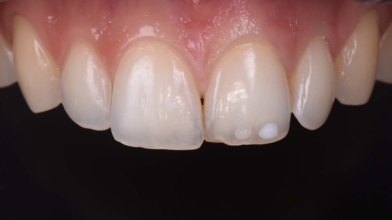 Selecting the composite shade.