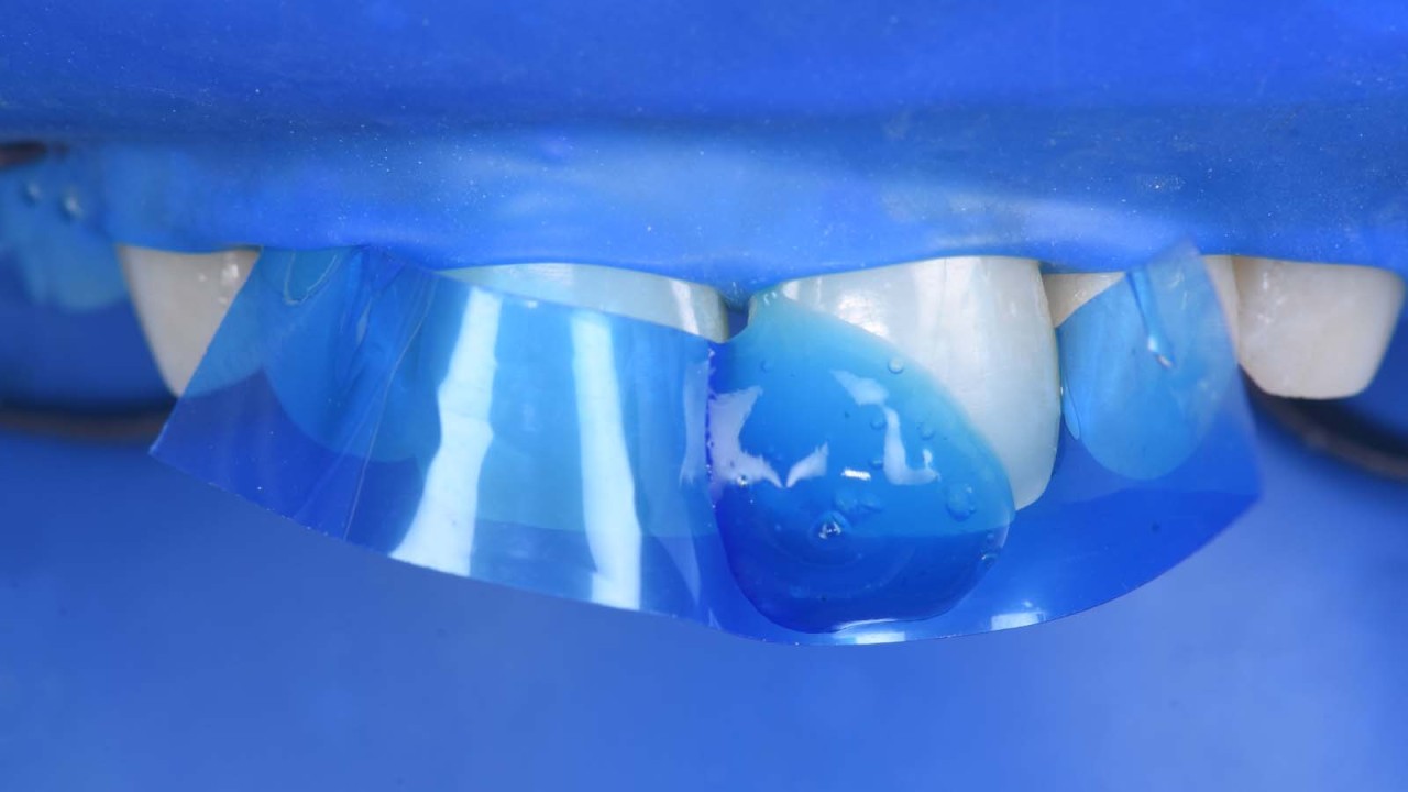 Preparing the tooth surface: Etching with iBOND Etch 35 Gel for 20 seconds.