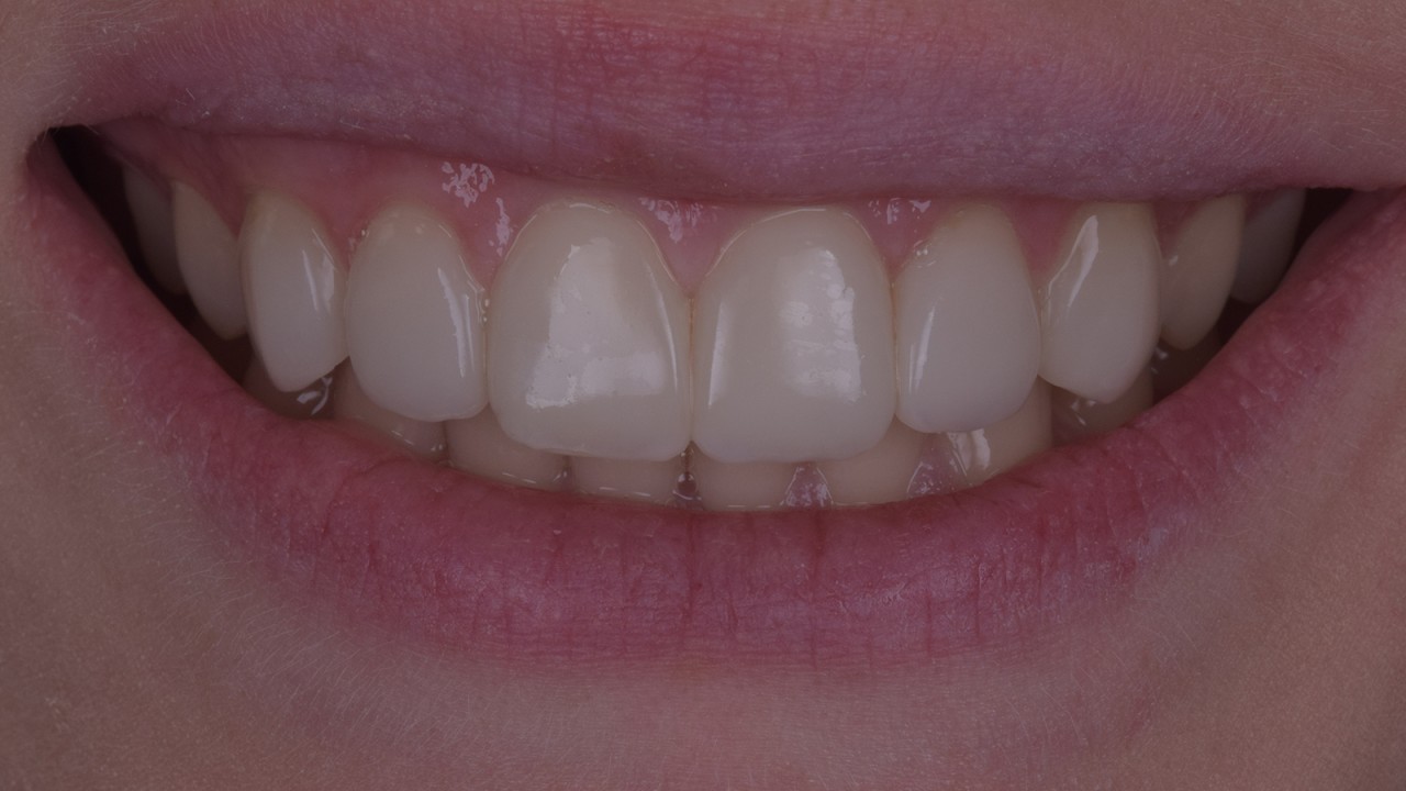 Result after 4 years, following a quick repolish